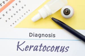 Chart for testing visual acuity, eye drops and eye anatomical model lies next to inscription Diagnosis Keratoconus. Concept for diagnosis, treatment and prevention of ophthalmic disease Keratoconus